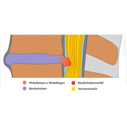 Bandscheibenbedingte und chronische Rückenschmerzen