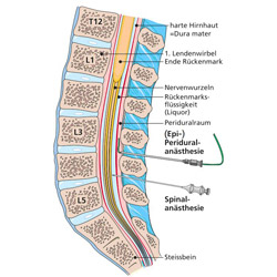 Degenerative Spinalkanalstenose