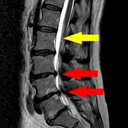 Degenerative Spinalkanalstenose